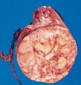 Wilms Tumor (Nephroblastoma)