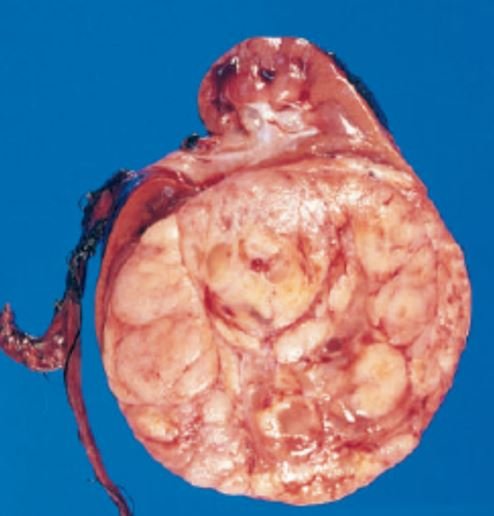 gross of wilm's tumor
