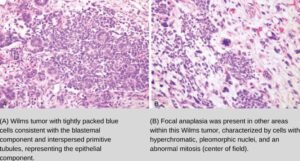 microscopy of wilms tumor
