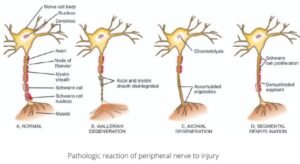Guillain-Barre syndrome