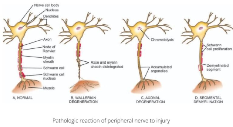 Guillain-Barre syndrome