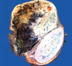 gross of pheochromocytoma