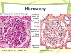 Acute post-streptococcal glomerulonephritis