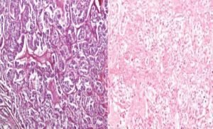microscopy of pheochromocytoma