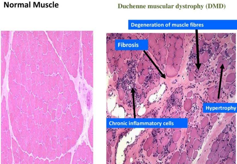 Muscular Dystrophy