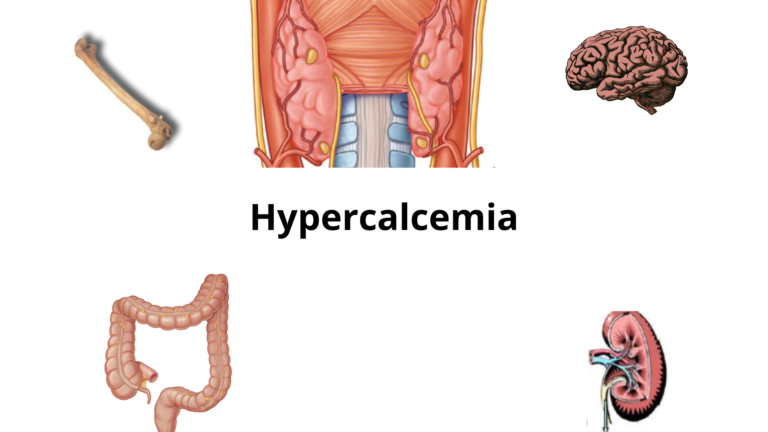 Hypercalcemia