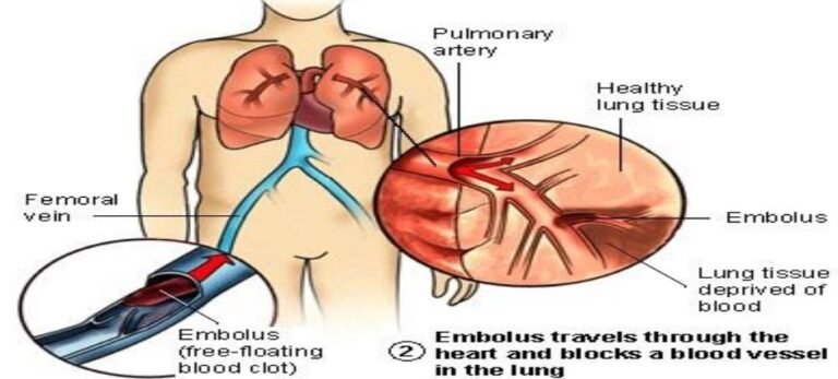 Pulmonary thrombo-embolism