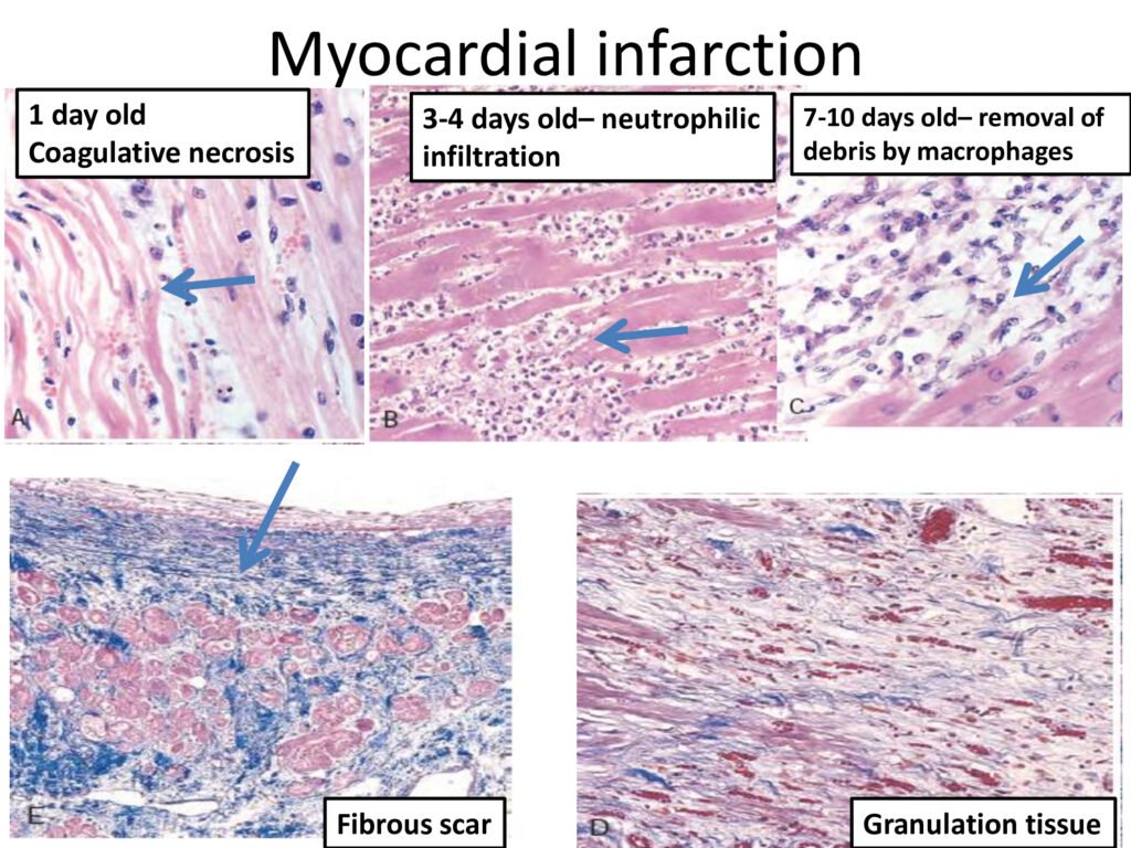 Infarction: Types, Pathogenesis, Morphology - NotesMed | NotesMed