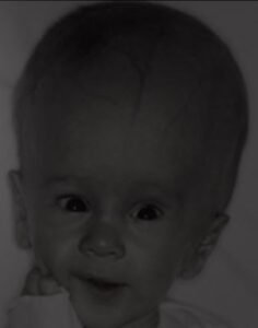 hydrocephalus