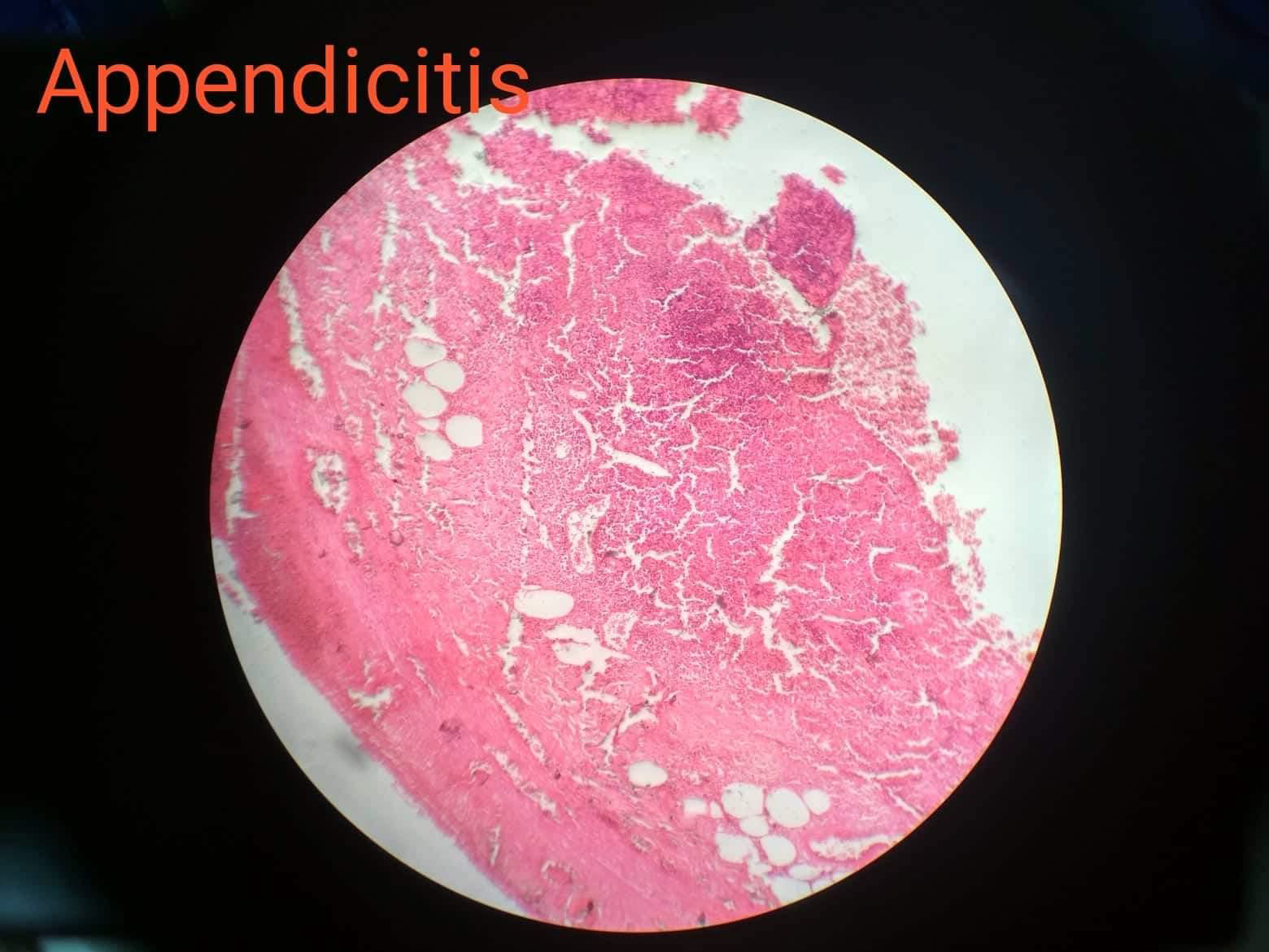 appendicitis