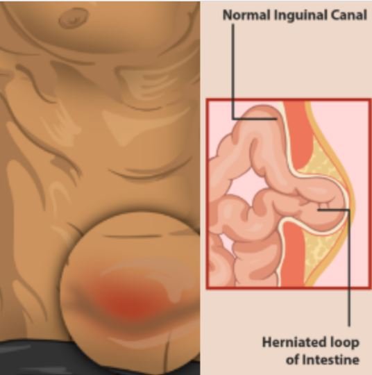 inguinal hernia