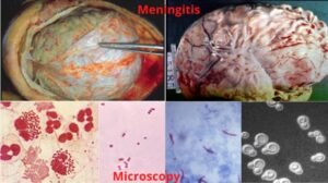 meningitis