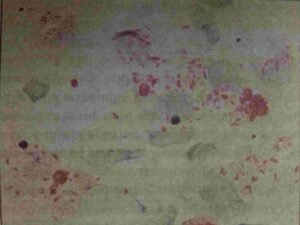 Mycobacterium leprae