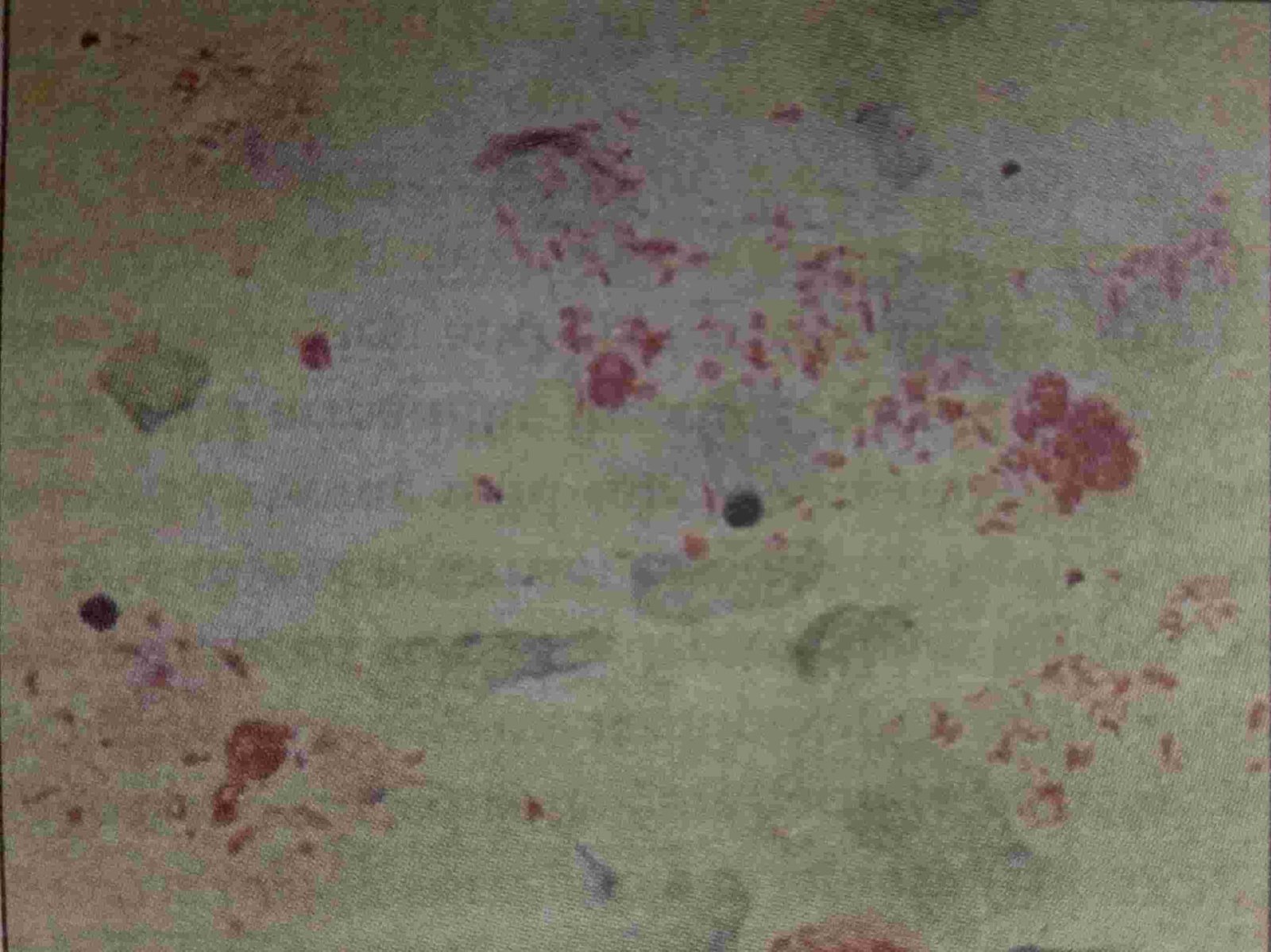 mycobacterium leprae