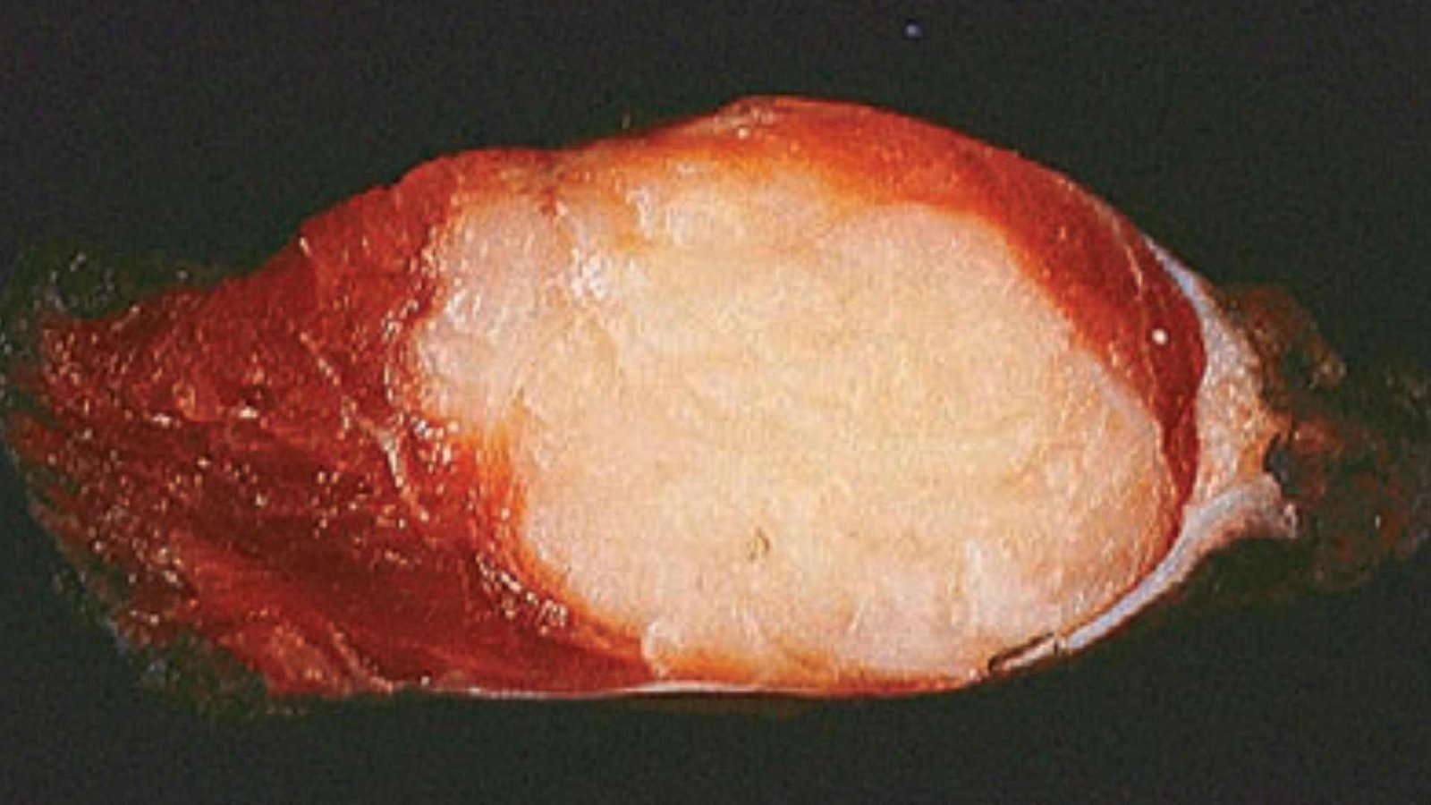 RHABDOMYOSARCOMA GROSS