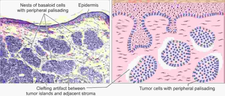 BASAL CELL CARCINOMA