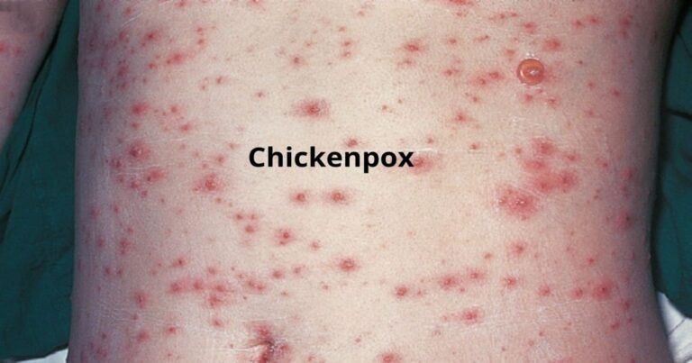 chickenpox