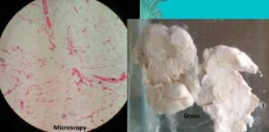 lipoma