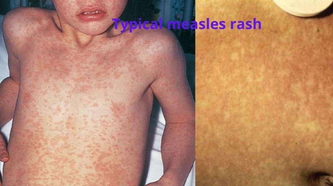 measles