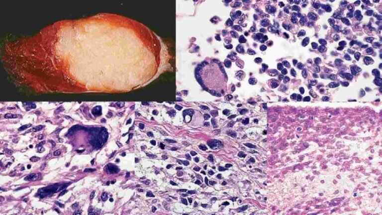 rhabdomyosarcoma