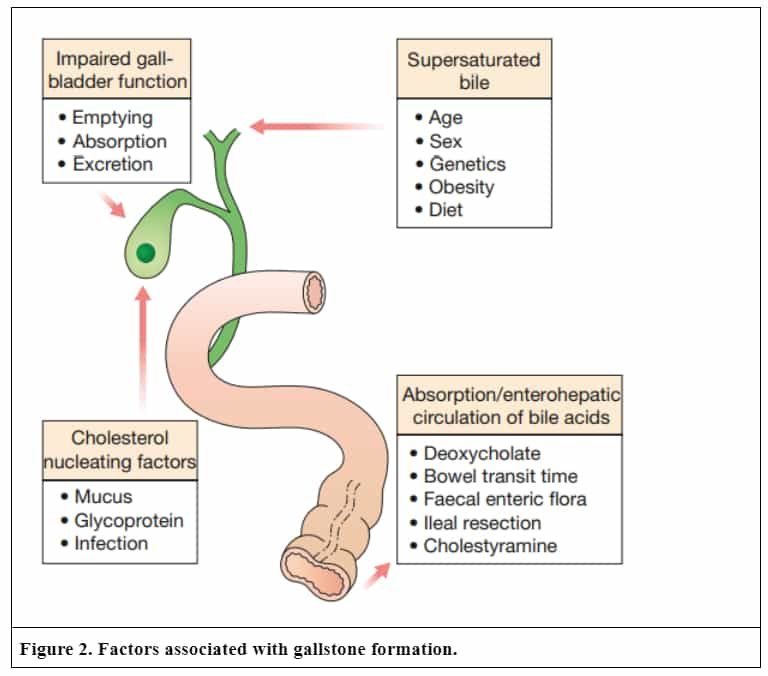 Gallstones disease (symptomatic cholelithiasis)