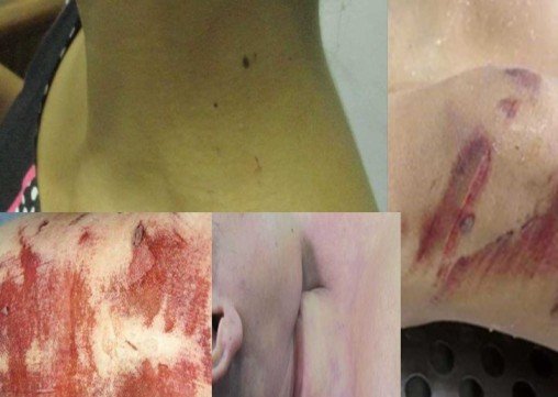 Mechanical injuries
