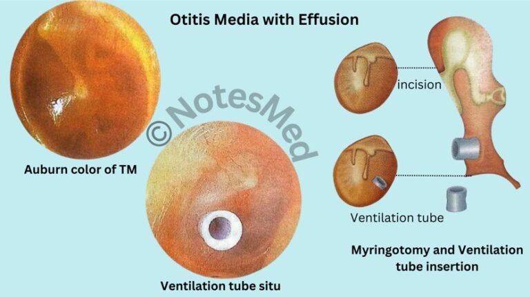 Otitis Media with Effusion (OME)