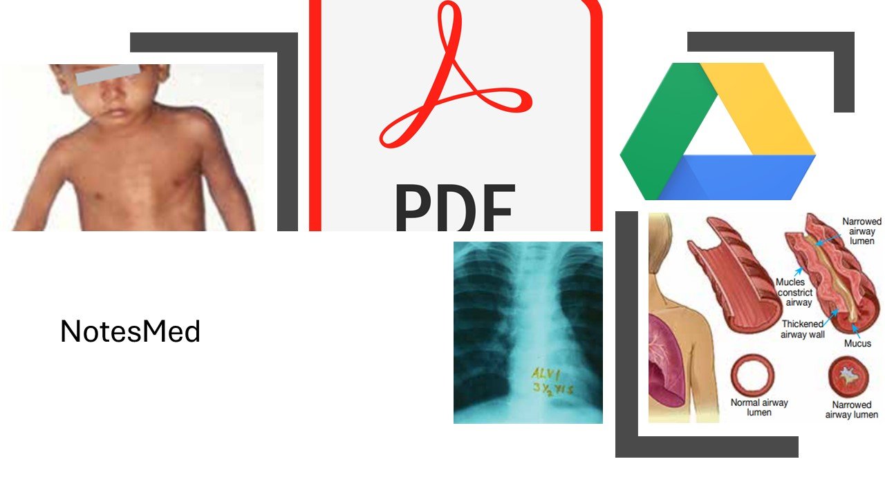 Bronchial asthma: Pathophysiology, Clinical features, Management