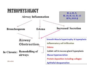 bronchial asthma