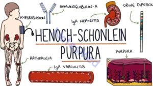henoch-Schonlein-Purpura-symptoms