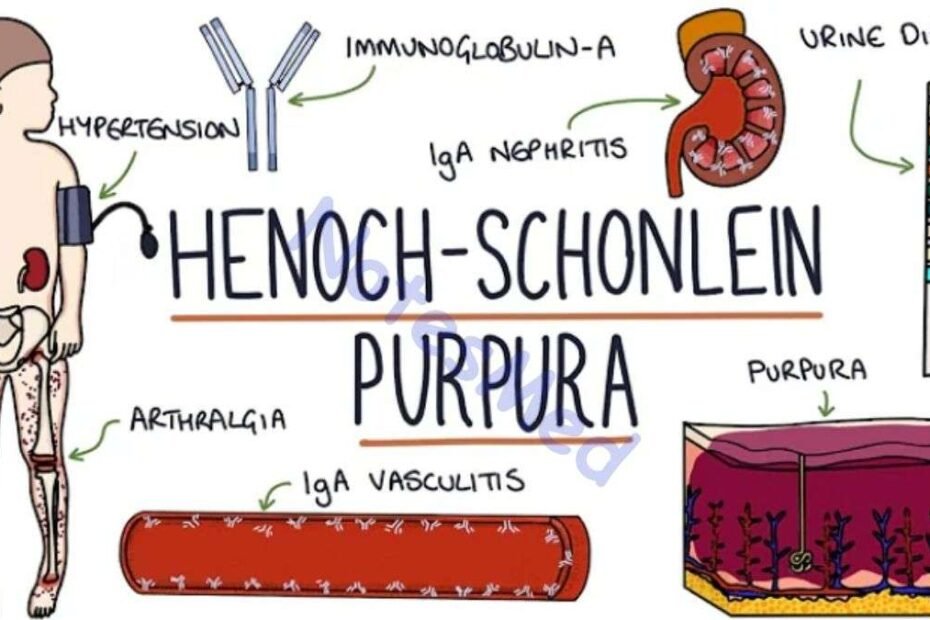 henoch-Schonlein-Purpura-symptoms