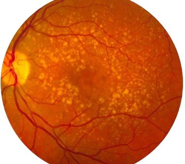 age-related macular degeneration